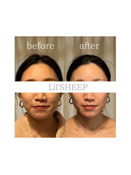 リルシープ(LIL'SHEEP)/眠れる小顔コルギ1回施術