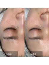 モモ(momo)/お顔全体の毛穴ケア！