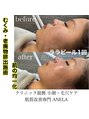 アネラ(ANELA)&nbsp;顔筋マッサージでお顔の老廃物を流し、歪みを整えます