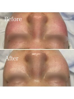 リノユー ビューティー(Lino U Beauty)/【ビオフィートで毛穴レス肌♪】