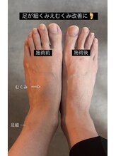 ローリエ/むくみ改善に