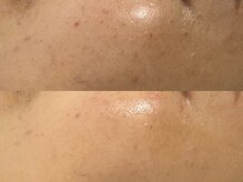 ホロホロ(holoholo)/セラピール☆ビフォーアフター２