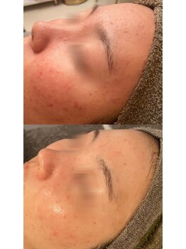 ビジュープラス(Bijou+)/剥離無しハーブピーリング