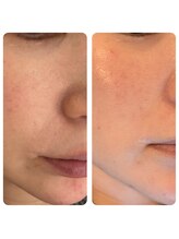 ティア(TIA)/メソスキンカラー