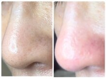 ミント/鼻の赤味はすぐに収まります