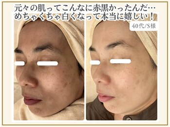 ポモナ 横浜馬車道店(Pomona)/シミ、くすみがなくなり若見え◎