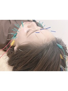 鍼灸施術を受けたい