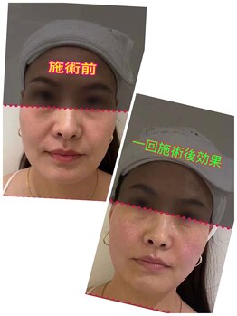 東洋経絡エステ アンド リラクゼーション/フェスライン、リフトアップ効果