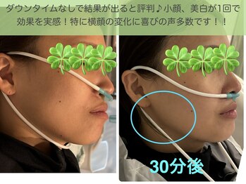 ヨサパーク ベスティ 阿佐ヶ谷(Yosa Park bestie)/顔ビフォアフ:水素吸入1回