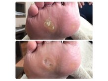 厚木 海老名 巻き爪矯正センター/事例【ドイツ式フットケア】