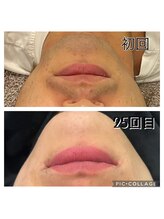 レイモード(Ray mode)/髭脱毛(爆抜け)