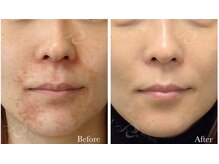 クリア 麻布十番(CLEAR)/リベルハーブピーリング施術5回