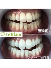 ルブラン 奈良店(Le Blanc)/着色は落とせます！