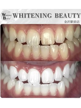 ホワイトニングビューティー 金沢駅前店(WHITENING BEAUTY)/自分史上最高の歯へ♪