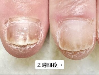 グラシナ なんば店/深爪/自爪育成/フィルイン