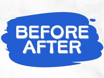 LBSホワイトニング 梅田店/歯のBefore　After