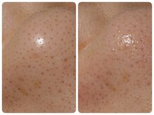 トータルビューティ ノイド(Noid)/いちご鼻　撃退コース