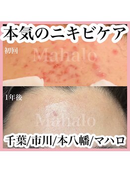 マハロ(Mahalo)の写真/メンズの爽やかさは肌で決まる！肌管理で自信UP☆ニキビケアも◎