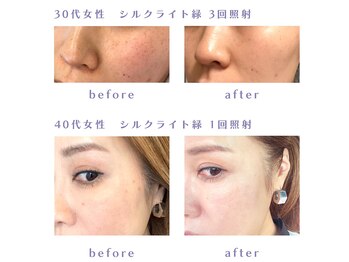 ミセル 尾道店(MYTHEL)/before　after　LEDライト