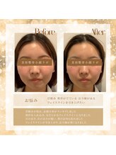 美容整骨小顔ラボ/ビフォーアフター