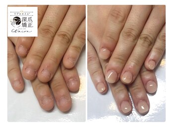 トイロ(toiro)/リプロネイルは初回で見た目改善