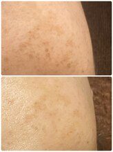 ギャラクシービューティー(galaxy beauty)/しみケア