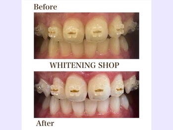 ホワイトニングショップ 守口店/before／After　14トーンUP