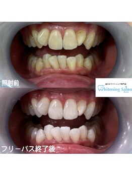 ホワイトニングサロン 熊本店/セルフホワイトニング