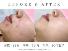 ロエヴェ(ROEWE)/ニキビ改善・毛穴ケア・肌質改善