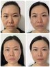 【男性・女性】ルネセル　ダイアモンドピール(60分)45000→29800
