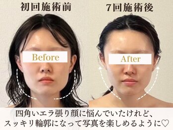 サロンキャン(Salon.CAN)/エラ改善！プレミアムコース