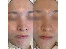 ルブドワール(Le Boudoir)/肌質改善3ヶ月プログラム