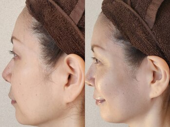 フリージア(Freesia)/【3】　ヒト幹細胞フェイシャル