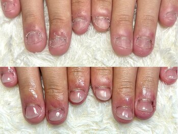 グラシナ なんば店/深爪/自爪育成/フィルイン