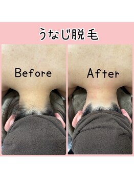 ミース 市川店/★うなじ脱毛BeforeAfter