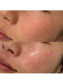 ラ クレール ビューティーサロン(LA CLAIR)/ホワイトラボ×水光ピール