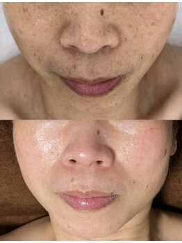 ヨルエステ(yoru aesthe)/【エイジング、毛穴洗浄】