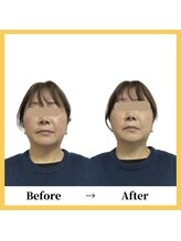 美容整体 レモン/たるみ、小ジワケア