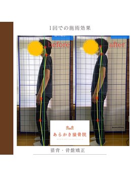 あらかき接骨院/【姿勢の変化】