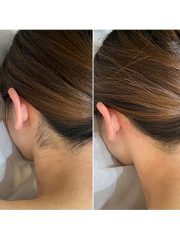 インベスト(INVEST)/うなじ脱毛