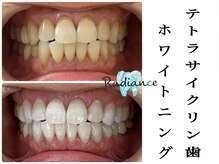 札幌セルフホワイトニング ラディアンス(Radiance)/テトラサイクリンホワイトニング