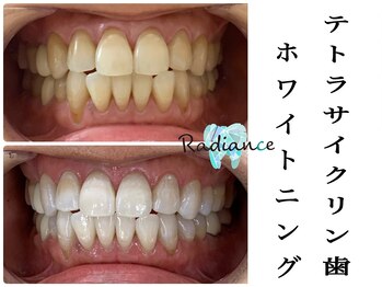 札幌セルフホワイトニング ラディアンス(Radiance)/テトラサイクリンホワイトニング