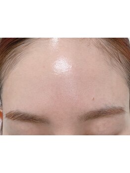 ホウレイ線・たるみ改善！予防ケア