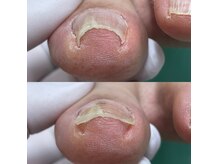 巻き爪補正店 広島紙屋町店の雰囲気(巻き爪ケア♪特許取得の特殊プレートでお痛み少なく形改善します)