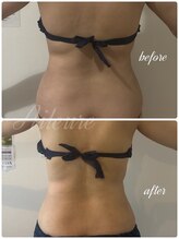 エルール トータルビューティ(Aileure total beauty)/ダウンタイムケア　インディバ