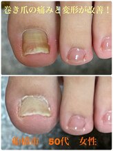 巻き爪じゅん 千葉駅前店/巻き爪痛み変形の悩みに答えます