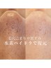 【角栓詰まり/黒ずみ】ザラザラ鼻の毛穴は水素ハイドラで一掃¥9900→¥7700
