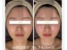 小顔フルコース&美肌【小顔たるみリフト＆ヒト幹細胞導入】デコルテ&ヘッド付