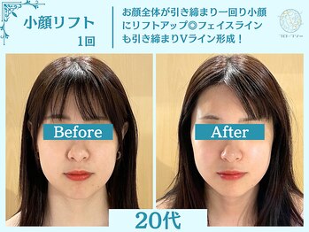 フローフシ∞/【小顔】切らない小顔リフト