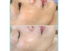 エイプリルプラス(April plus)/光フェイシャル